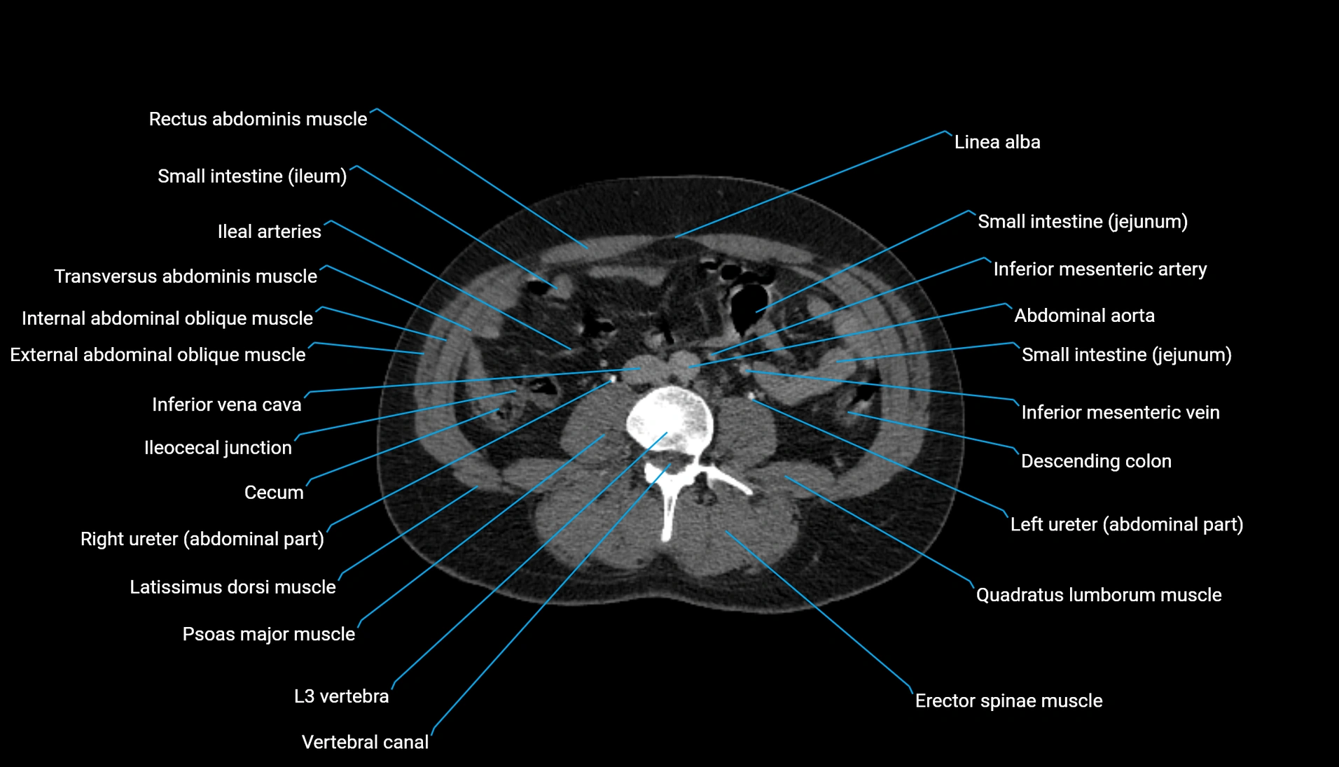 CT urogram axial cross sectional anatomy  labelled radiology image-00138.webp